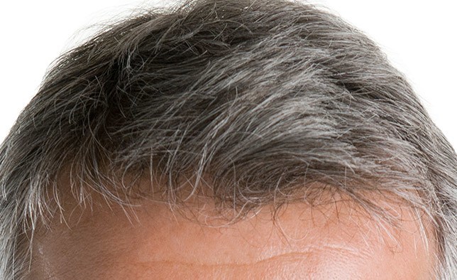 Hair Transplant Toronto s02