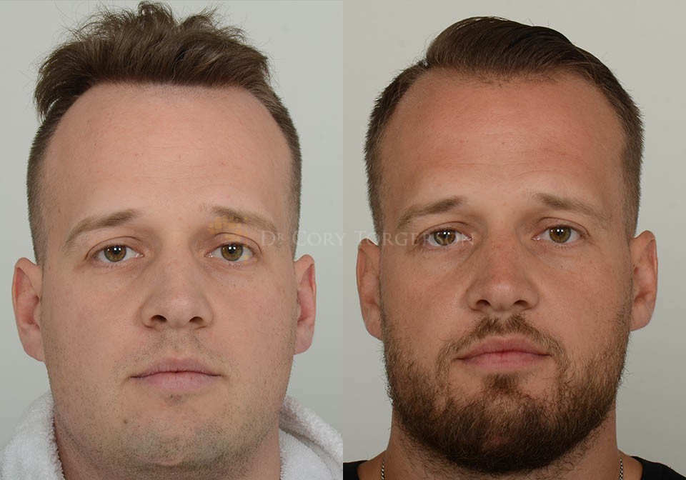 Chin Implant Before & After Gallery | Dr. Cory Torgerson