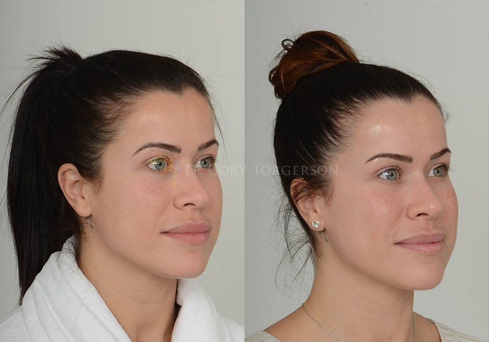 Chin Implant Before And After The Ultimate Guide To Finding The Right Surgeon - bsg4d2x