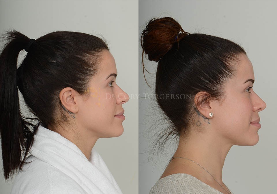 Chin Implant Before And After I Cant Believe The Results - y0ut5nh