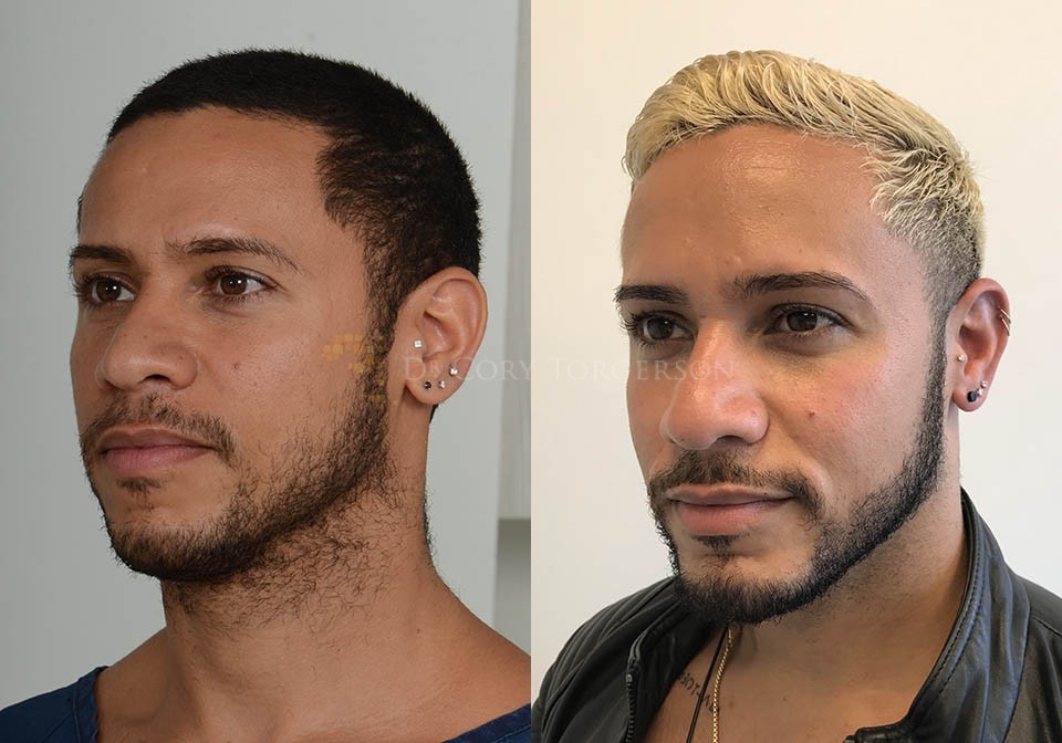 Chin Implant Before & After Gallery | Dr. Cory Torgerson