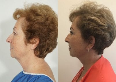 Facelift Before After P104 3