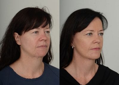 Facelift Before After P105 1