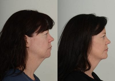 Facelift Before After P105 2