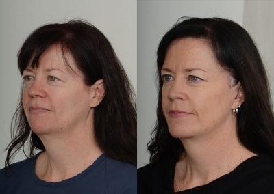 Facelift Before After P105 4