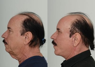 Facelift Before After P106 3