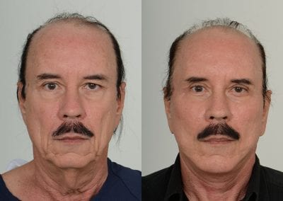 Facelift Before After P106