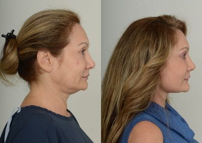Facelift Before After P107 2