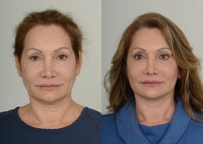Facelift Before After P107