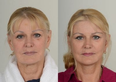 Facelift Before After P108