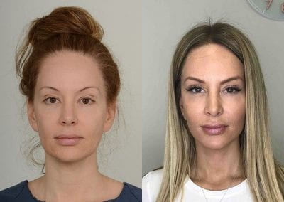 Facelift Before After P109