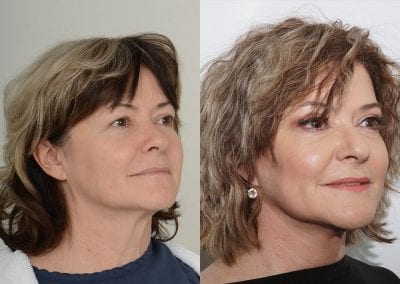 Facelift Before After P110 1
