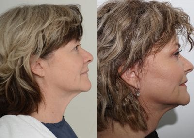 Facelift Before After P110 2