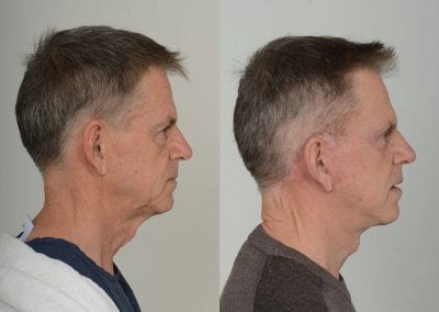 Facelift Before After P111 2