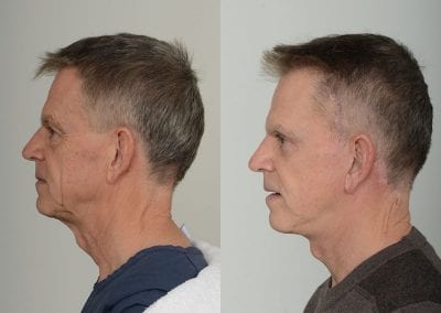Facelift Before After P111 3