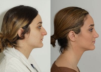 Rhinoplasty Before After P149 2