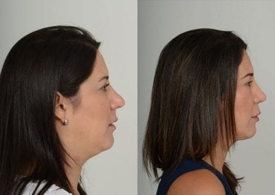 Rhinoplasty Before After P151 2