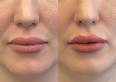 Lip Flip Before After P4 1