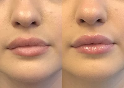 Lip Flip Before After P5 1
