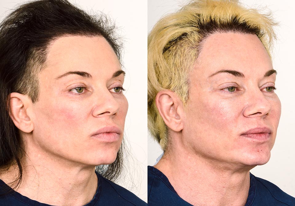 Chin Implant Before & After Gallery Dr. Cory