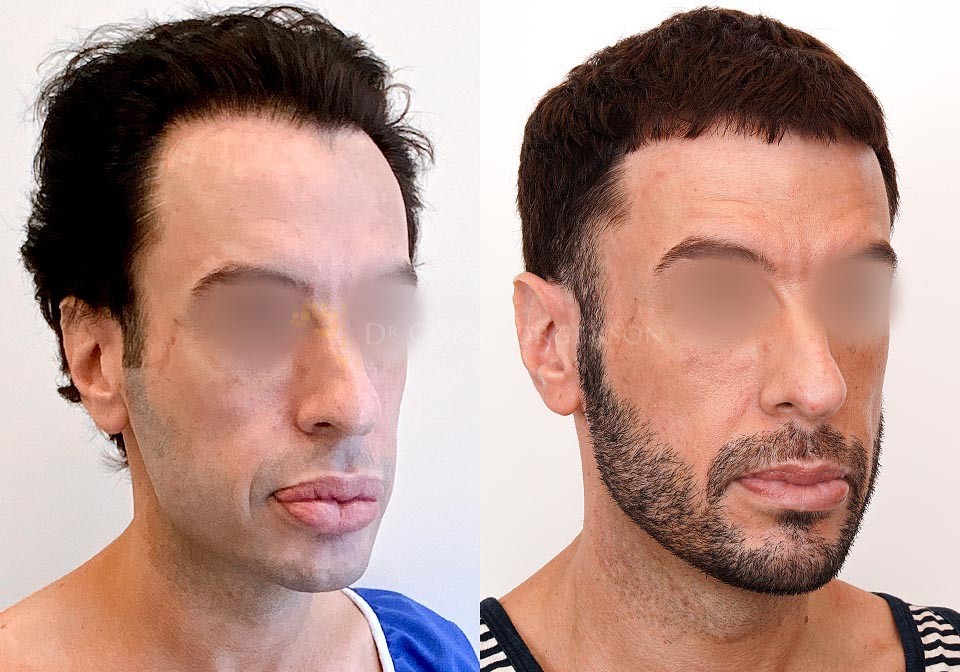 Lip Reduction Before & After Gallery Dr. Cory