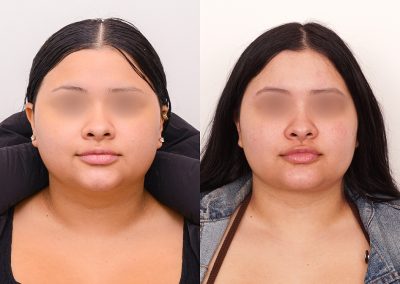 Neck Liposuction Surgery Before After P1 1