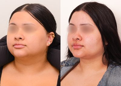 Neck Liposuction Surgery Before After P1 3