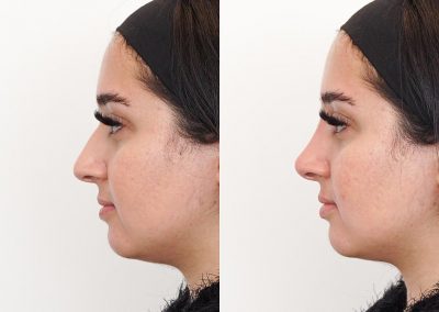 Non Surgical Nose Job Before After P17 1