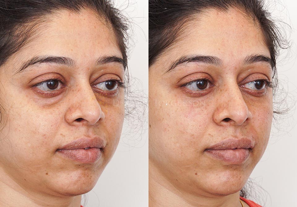 Under Eye Filler Before & After Gallery Dr. Cory