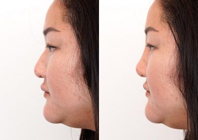 Non Surgical Nose Job Before After P20 5