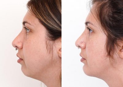 Chin Implant Before After P112 5
