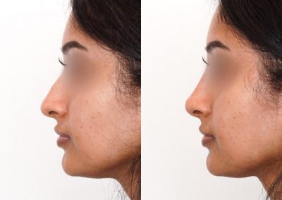 Non Surgical Nose Job Before After P24 4
