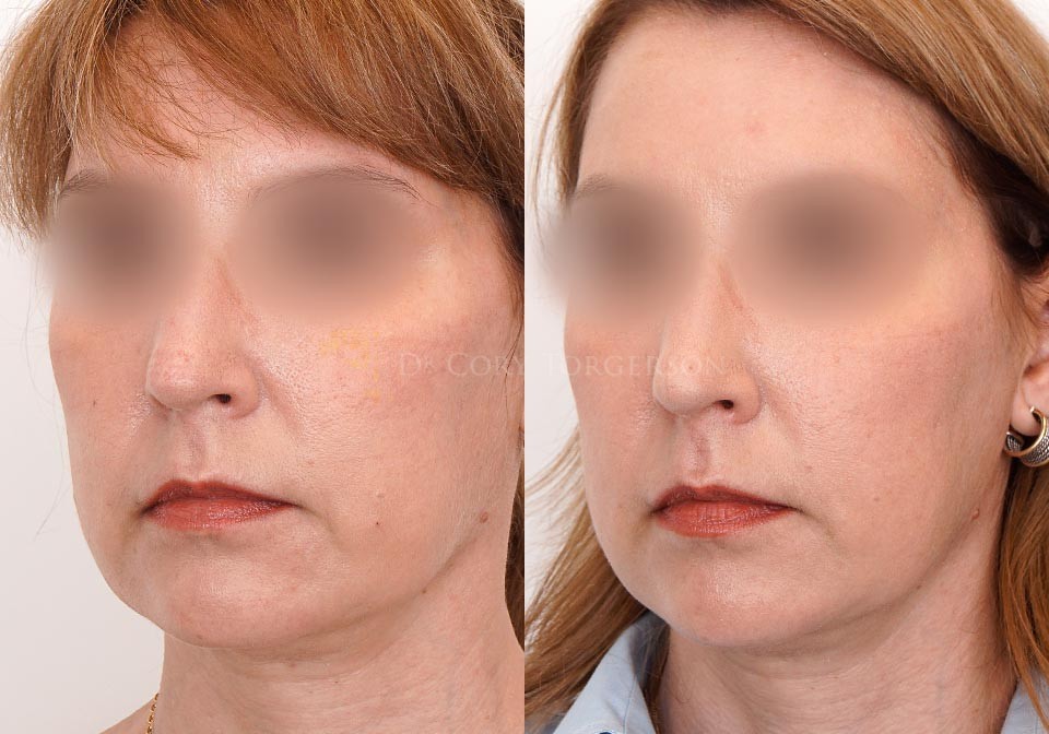 Thread Lift Before & After Gallery | Dr. Cory Torgerson