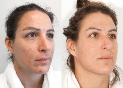 CO2 Laser Before After P4 3