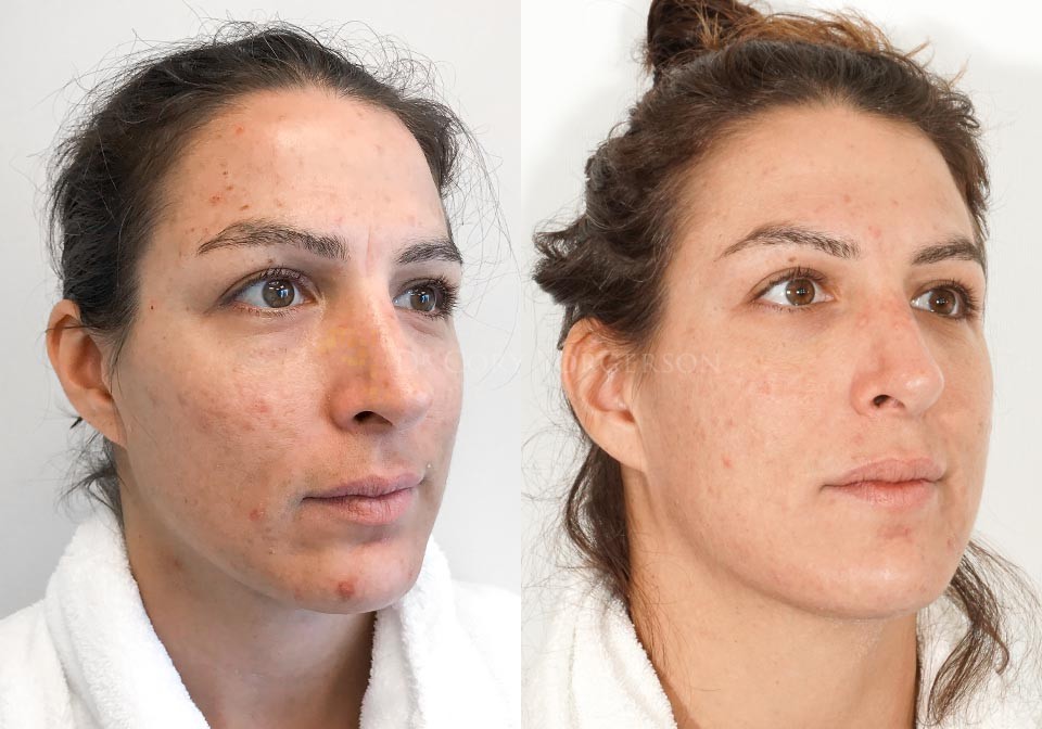Rejuvenate your skin with our Carbon Dioxide Laser treatment