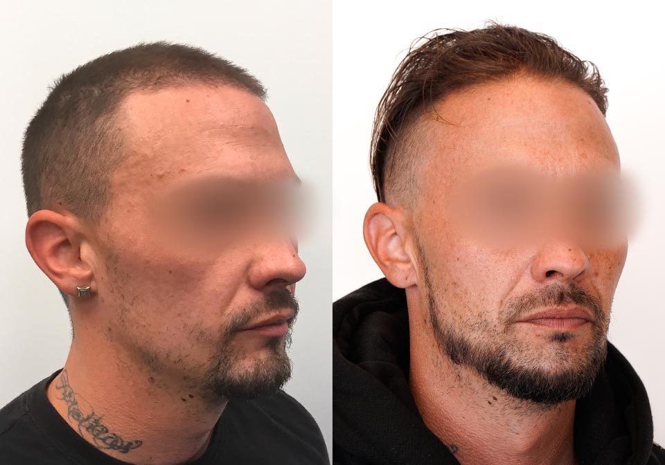 Beard Transplant Before & After Gallery Dr. Cory