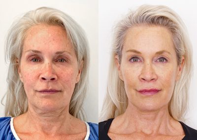 Facelift Before and After Patient Top 3 2