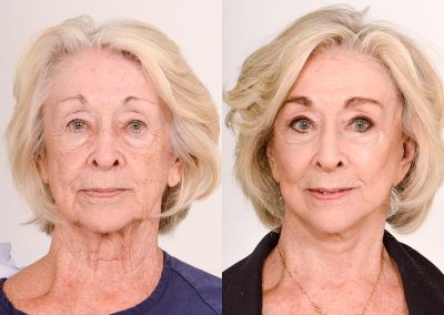 Facelift Before and After Patient Top 3 3