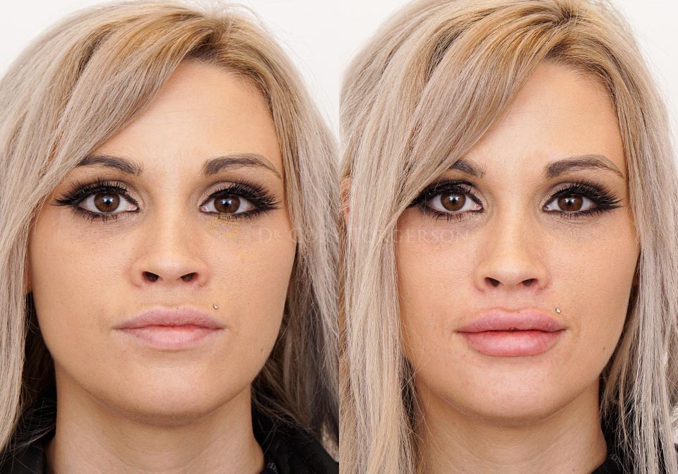 Lip Fillers Before & After Gallery | Dr. Cory Torgerson