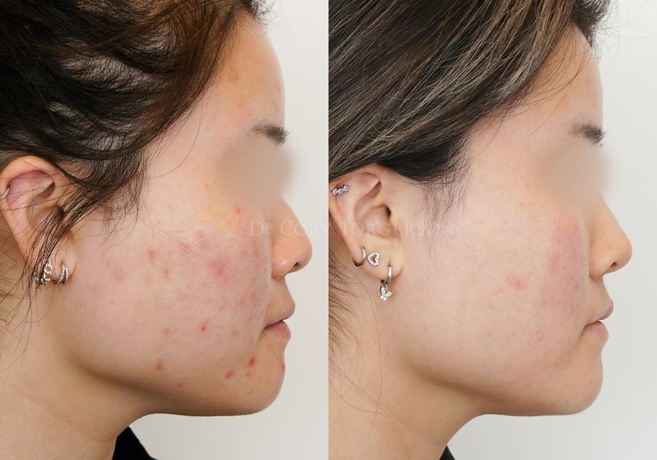 Laser Acne Treatments Before & After Gallery Dr. Cory