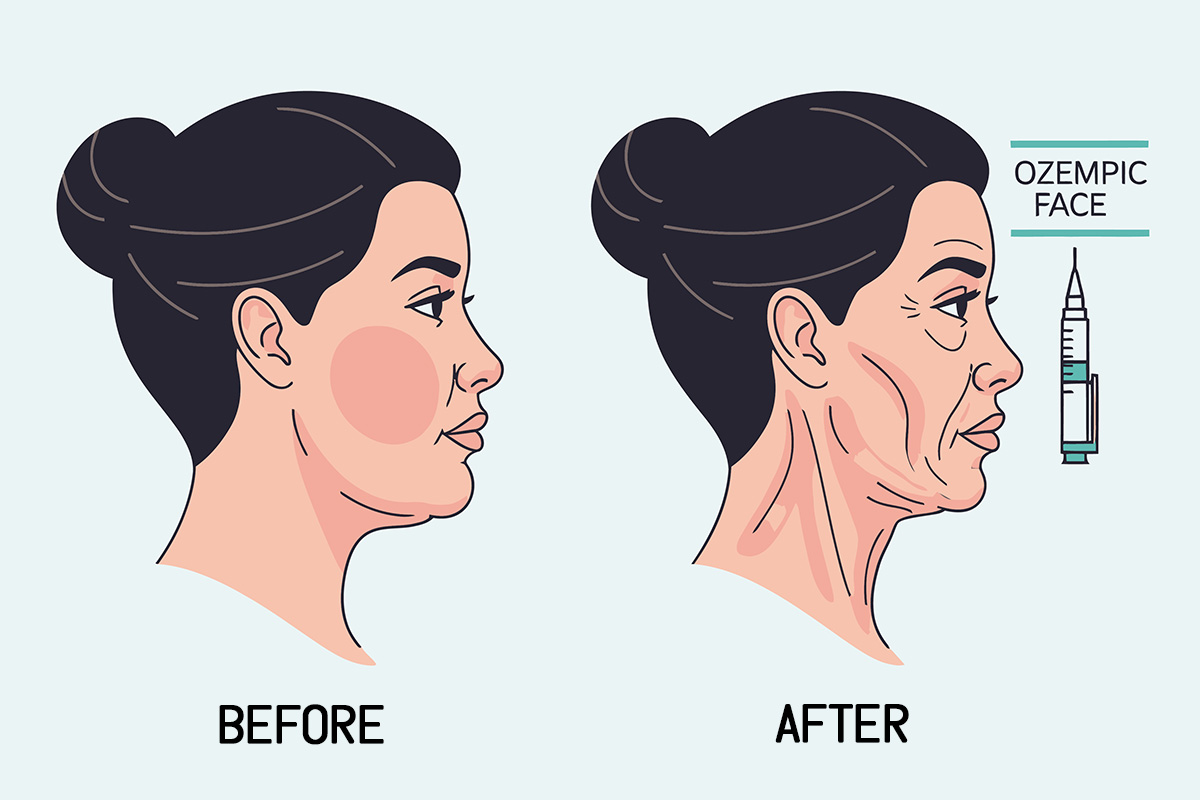 What You Should Know About Ozempic Face