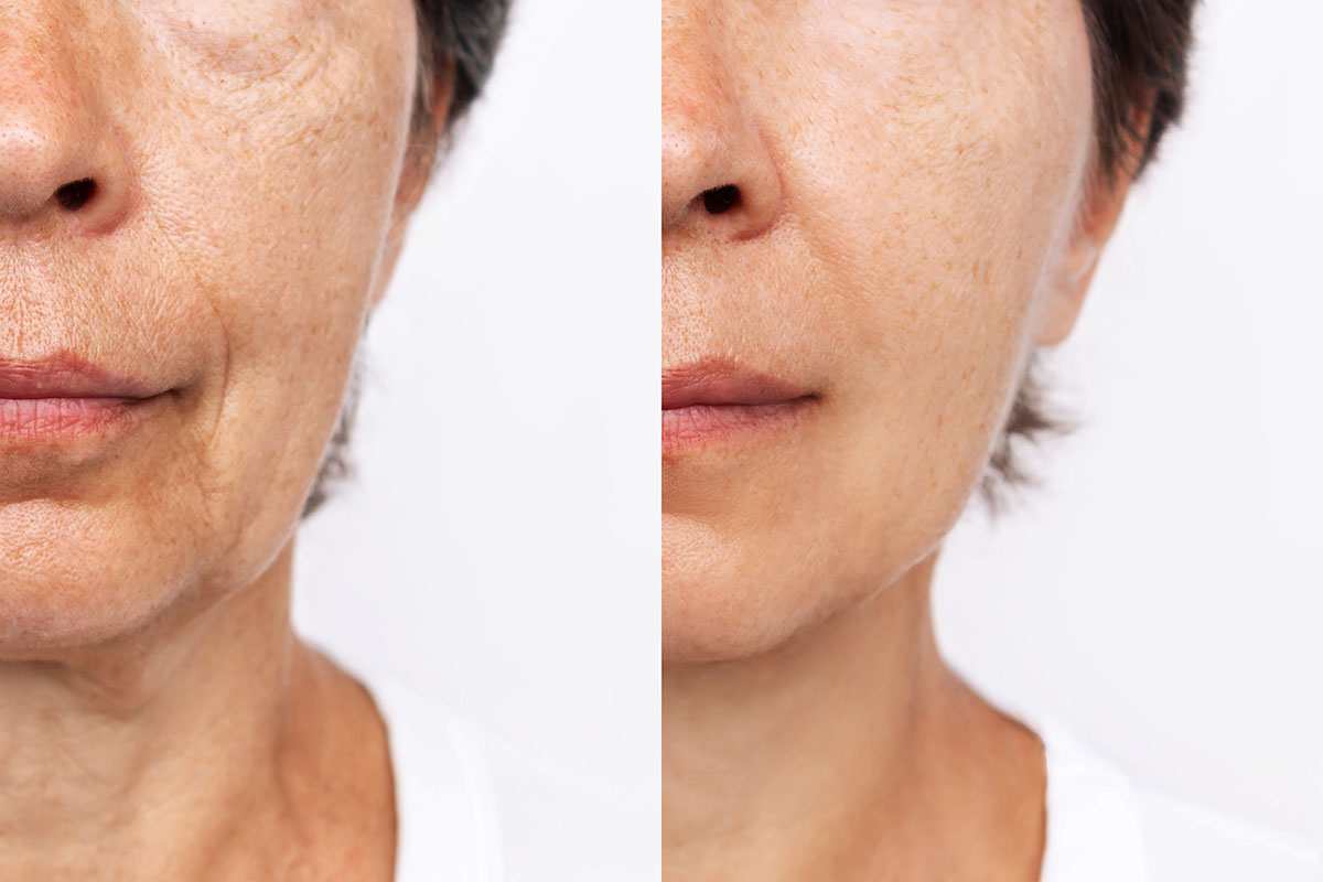 Deep Plane Facelift Before & After