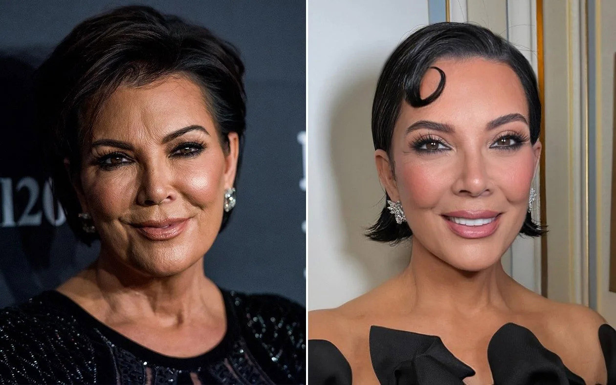 Kris Jenner Before & After $100K Facelift