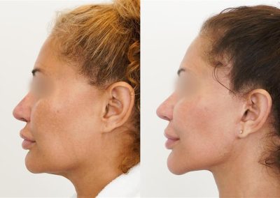 Ponytail Lift Toronto Mini Facelift Patients