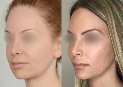 Ponytail Lift Toronto Mini Facelift Patients