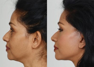 Ponytail Lift Toronto Mini Facelift Patients