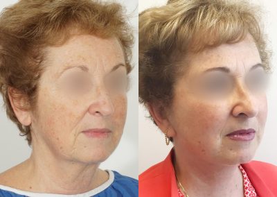 Ponytail Lift Toronto Mini Facelift Patients